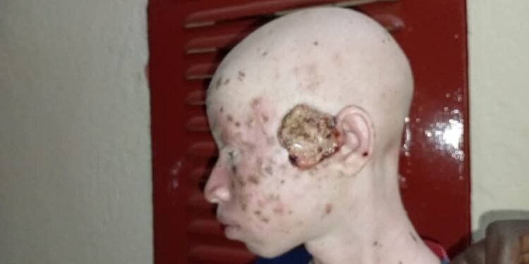 Dinguiraye : Appel à l’aide pour Aliou Kéita, un élève de 12 ans atteint d’un cancer.