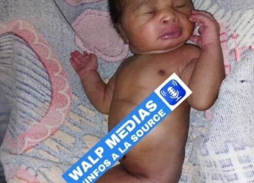 Faranah : Naissance d’un nouveau-né présentant une malformation rare à Bontala