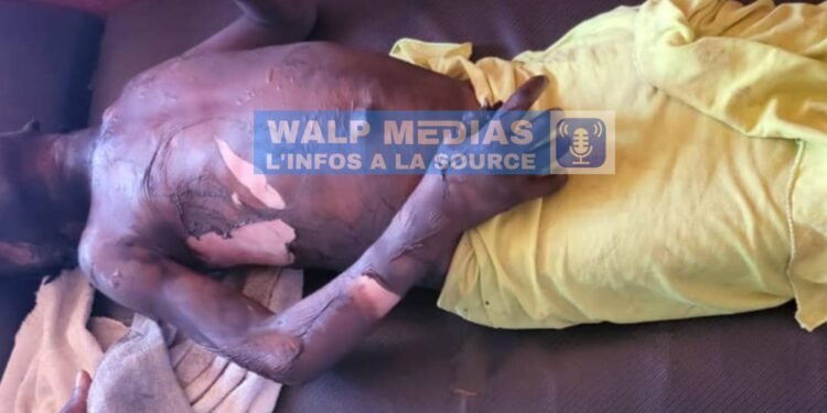 Crime odieux à Mandiana: Une fillette grièvement brûlée par la coépouse de sa mère