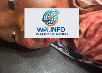 Siguiri : une fillette de 18 mois grièvement mordue au visage par son père