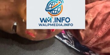 Siguiri : une fillette de 18 mois grièvement mordue au visage par son père
