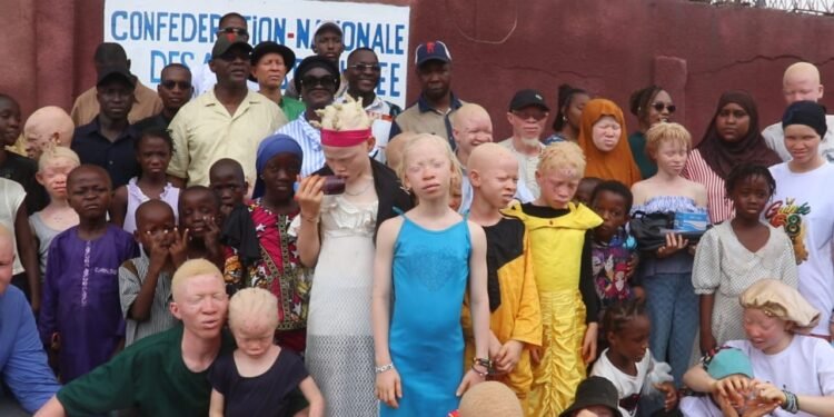 Sangoyah : Des enfants atteints d&rsquo;albinisme reçoivent des kits scolaires, un geste qui redonne espoir   